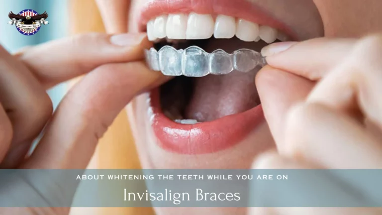 About Whitening the Teeth While You Are on Invisalign Braces